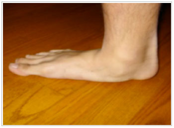 صافی کف پای بزرگسالان اکتسابی آسیب یا بد عملکردی تاندون تیبیال خلفی  صافی کف پای  درد در پاها، اندام تحتانی و ساق پا  کفی طبی   سخت  کفش محکم و ساق دار طبی   دفورمیتی شدید 